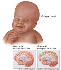 hydrocephalus是什么意思
