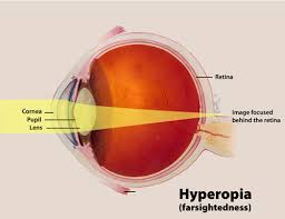 hyperopia是什么意思