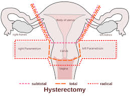 hysterectomy是什么意思