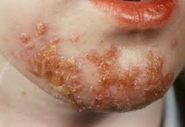 impetigo是什么意思
