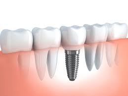 implant是什么意思