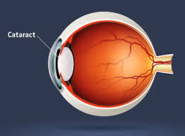 intraocular是什么意思