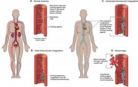 intravascular是什么意思