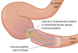 intussusception是什么意思