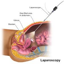 laparoscopy是什么意思