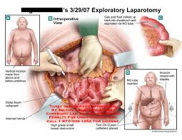 laparotomy是什么意思
