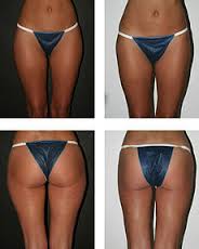 liposuction是什么意思