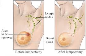 lumpectomy是什么意思