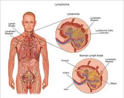 lymphoma是什么意思