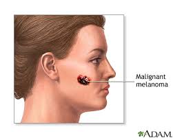 malignant是什么意思