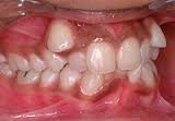 malocclusion是什么意思