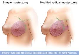 mastectomy是什么意思