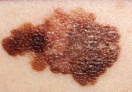 melanoma是什么意思