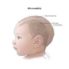 microcephalic是什么意思