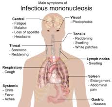 mononucleosis是什么意思