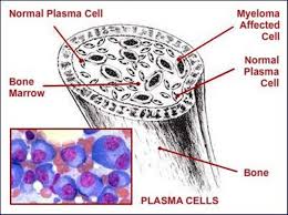 myeloma是什么意思