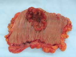 neoplasm是什么意思