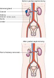 nephrectomy是什么意思