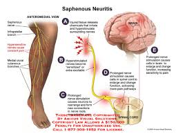 neuritis是什么意思