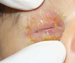 ophthalmia是什么意思