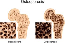 osteoporosis是什么意思