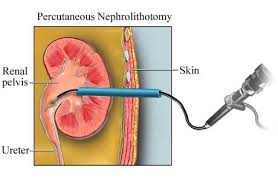 percutaneous是什么意思
