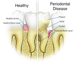 periodontal是什么意思