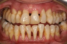 periodontitis是什么意思