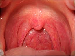 pharyngitis是什么意思