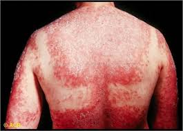 photosensitive是什么意思