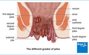 piles是什么意思