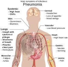 pneumonia是什么意思