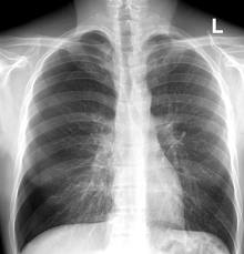 pneumothorax是什么意思