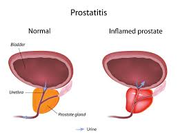 prostatitis是什么意思
