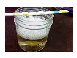 proteinuria是什么意思