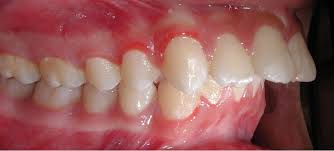 protrusion是什么意思