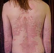 psoriasis是什么意思