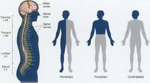 quadriplegia是什么意思