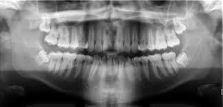 radiograph是什么意思