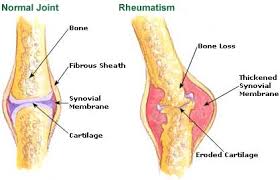 rheumatism是什么意思