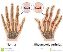 rheumatoid是什么意思