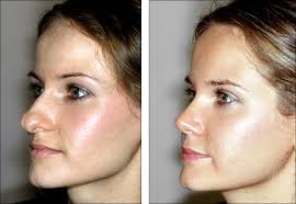 rhinoplasty是什么意思