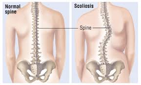 scoliosis是什么意思