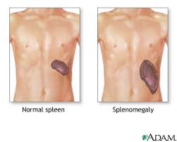 splenomegaly是什么意思