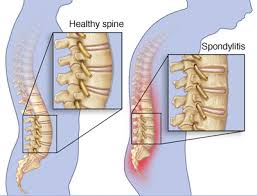 spondylitis是什么意思