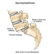 spondylolisthesis是什么意思