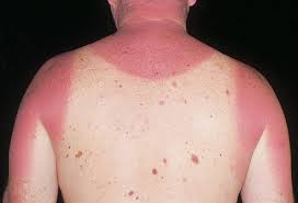 sunburn是什么意思