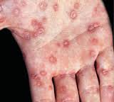 syphilis是什么意思