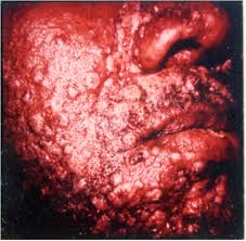syphilitic是什么意思