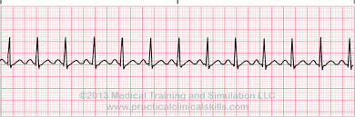 tachycardia是什么意思